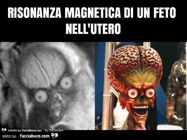 Risonanza magnetica di un feto nell'utero